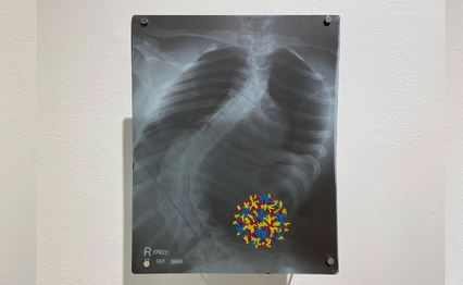 San Diego artist Bhavna Mehta's "Poliovirus 1" is a 2020 work of embroidery and beads on a 1984 X-ray. The work is part of "Script/Rescript," an exhibition on view at SDSU Art Gallery through Dec. 8, 2022.